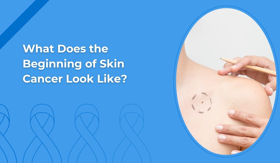 What does the beginning of skin cancer look like?