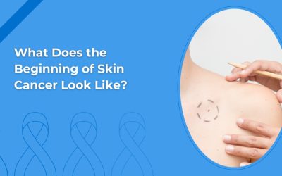 What Does the Beginning of Skin Cancer Look Like?