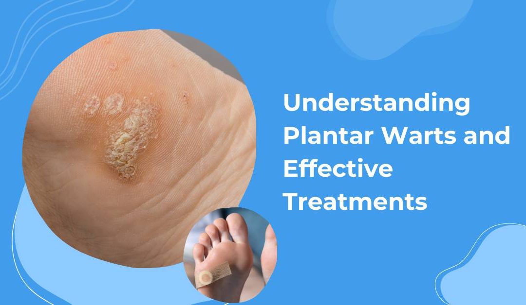 Are Plantar Warts Contagious