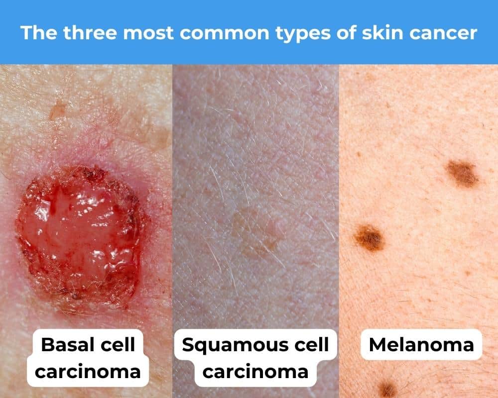 A visual of the three most common types of skin cancer